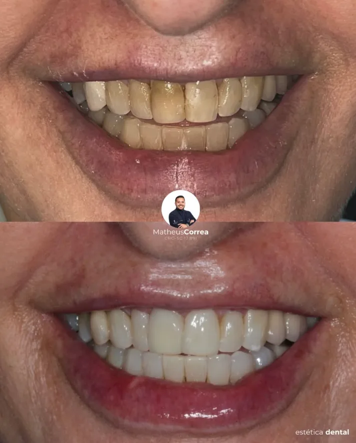 Caso clínico de facetas de porcelana em Florianópolis — Dr. Matheus Correa